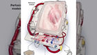 New System To Keep Donor Hearts Viable Longer