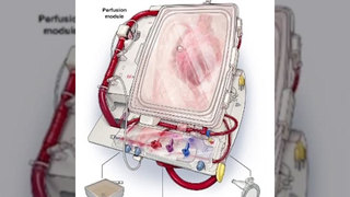 New System To Keep Donor Hearts Viable Longer
